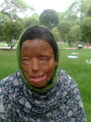 A beautiful life of Sonali Mukherjee melted away in an acid attack