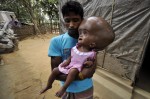 A kid suffers Hydrocephalus (Photo)